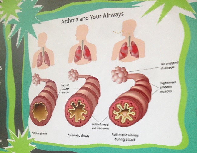 Asthma Airways